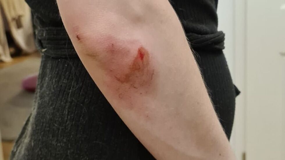 Auch am Ellenborgen hatte sie eine blutige Schramme. Auch am Ellenborgen hatte sie eine blutige Schramme.