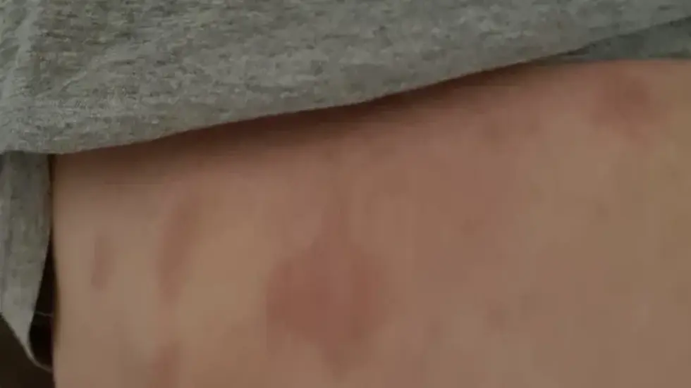 Hinterher hatten die beiden Frauen viele Hämatome von seinen Schlägen ...