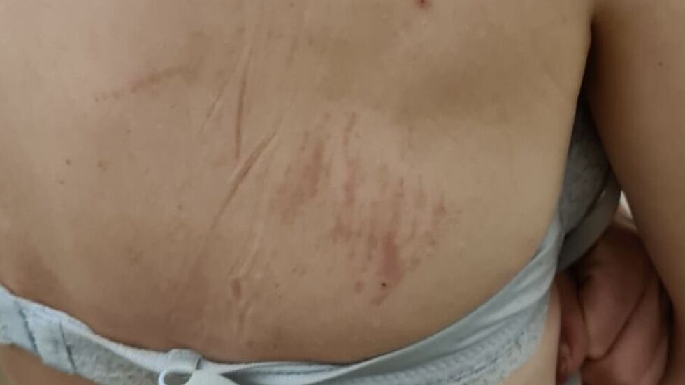 Lauras Rücken sah nach der brutalen Attacke überall übel aus. Lauras Rücken sah nach der brutalen Attacke überall übel aus.