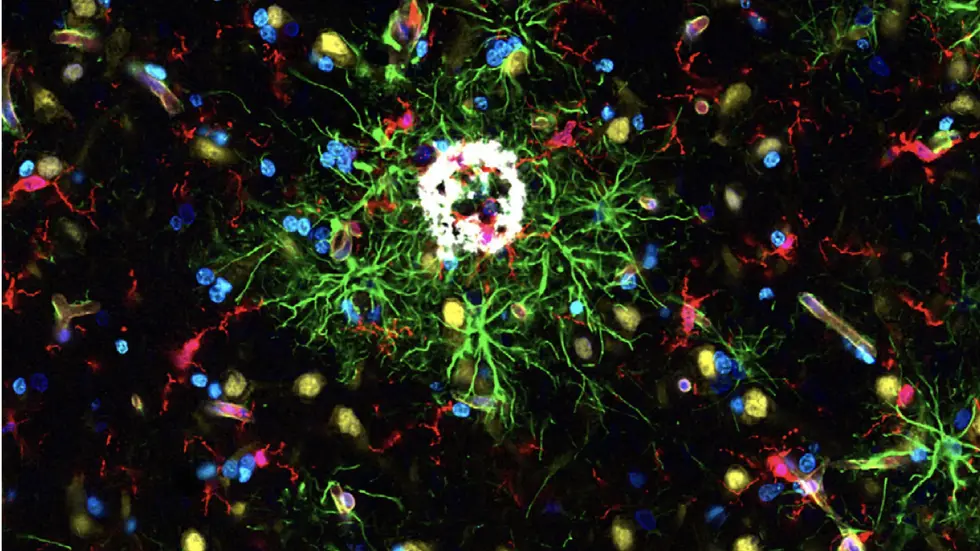 Repräsentatives Fluoreszenzbild eines Gewebsschnitts aus dem Gehirn eines an der Alzheimer-Krankheit erkrankten Körperspenders. Die verschiedenen Zellpopulationen des menschlichen Gehirns sind in unterschiedlichen Farben dargestellt, wobei Mikrogliazellen (rot) in unmittelbarer Nähe zu den für die Alzheimer-Krankheit typischen Proteinablagerungen (weiß) zu finden sind.