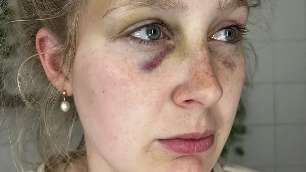 Denise (26) letztes Jahr kurz nach dem brutalen Angriff. 