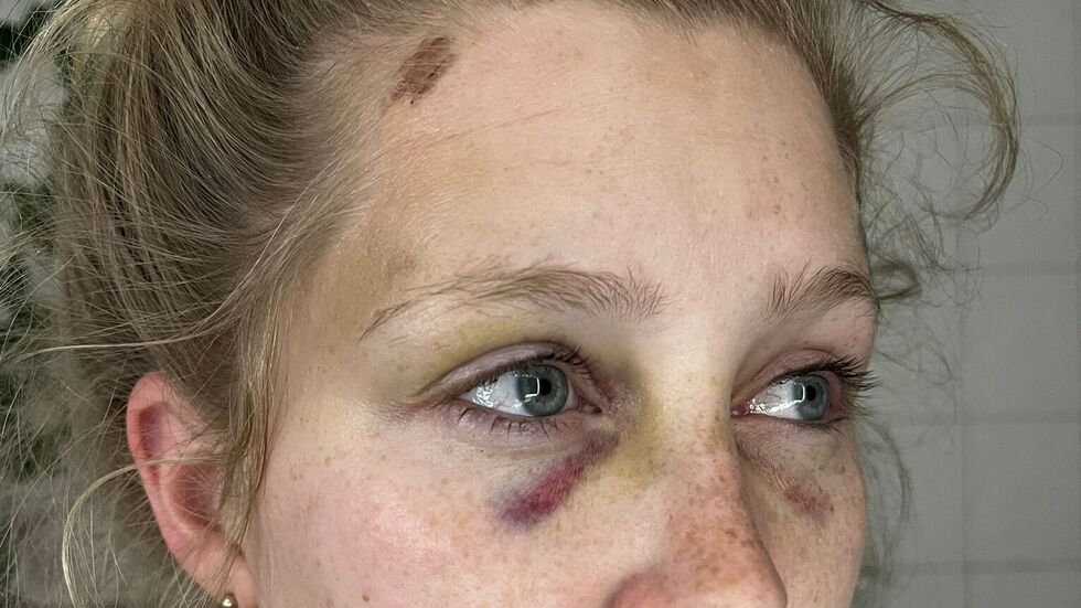 Denise wurde von dem jungen Mann besonders übel zugerichtet. Er habe ihren Kopf am Zopf festgehalten, ihn sechs Mal auf den Bordstein geschlagen und ihr gleichzeitig mit der anderen Hand die ganze Zeit dabei ins Gesicht geboxt. Denise wurde von dem jungen Mann besonders übel zugerichtet. Er habe ihren Kopf am Zopf festgehalten, ihn sechs Mal auf den Bordstein geschlagen und ihr gleichzeitig mit der anderen Hand die ganze Zeit dabei ins Gesicht geboxt.